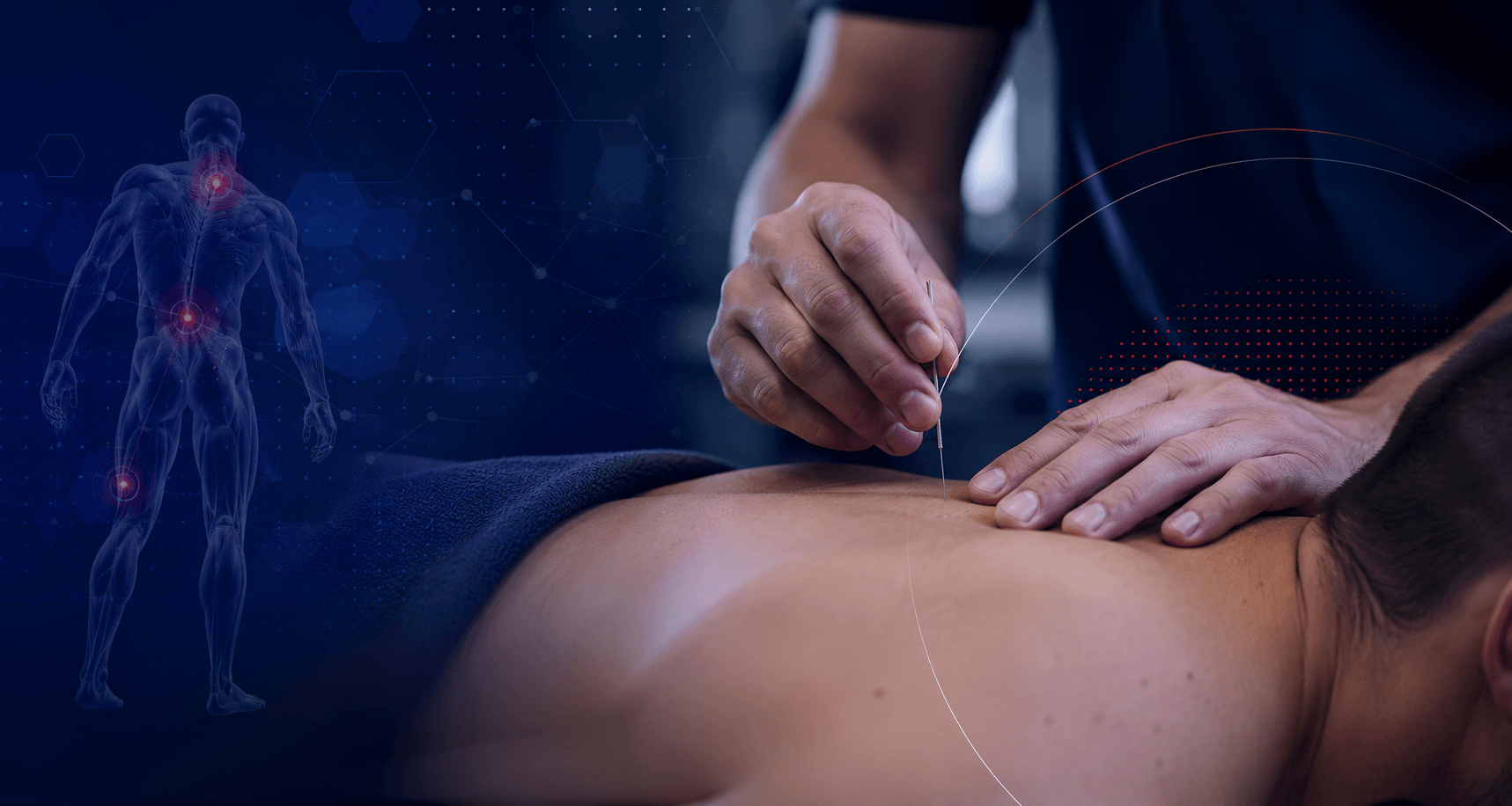 Εκπαίδευση Dry Needling και ξηράς βελόνας και ηλεκτροβελονισμού για φυσικοθεραπευτές σε Αθήνα, Θεσσαλονίκη, Κρήτη και Κύπρο