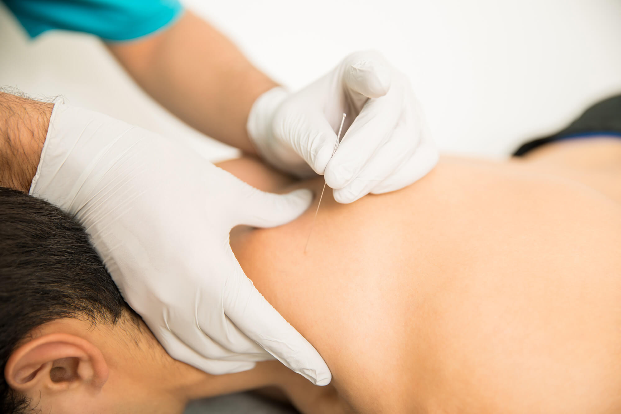 Σεμινάρια Dry Needling για φυσικοθεραπευτές σε Αθήνα, Θεσσαλονίκη, Κρήτη και Λευκωσία Κύπρου